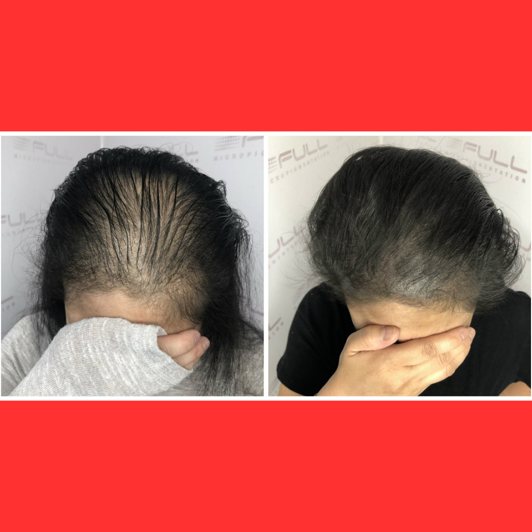 Hair Micropigmentation